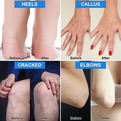 Intensive Repair Foot Cream for Cracked Heels & Calluses