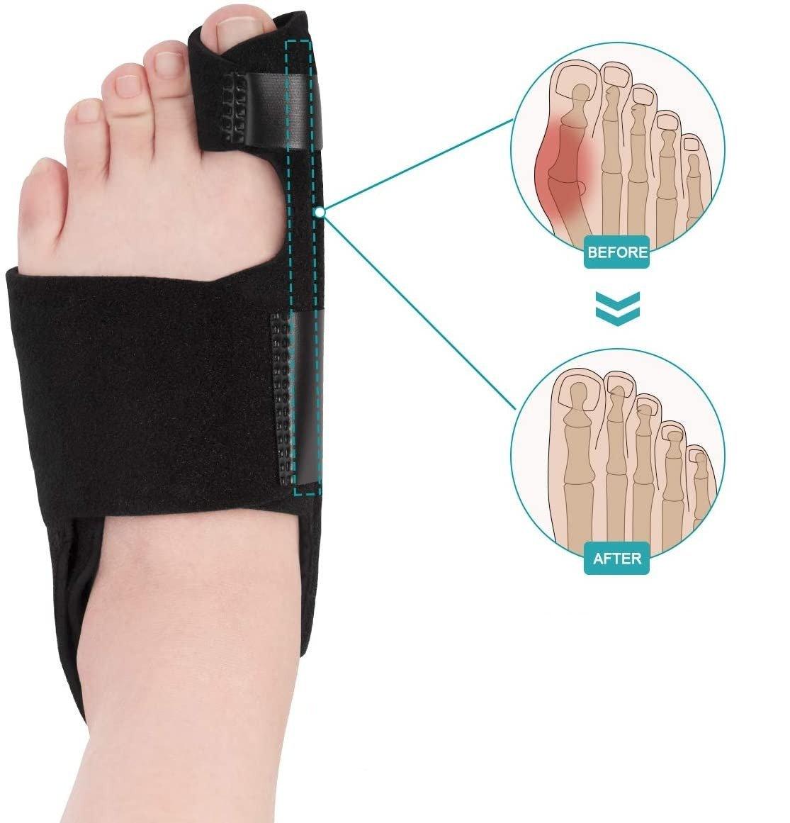 Bunion Splint for Severe Bunion - Bunion Free